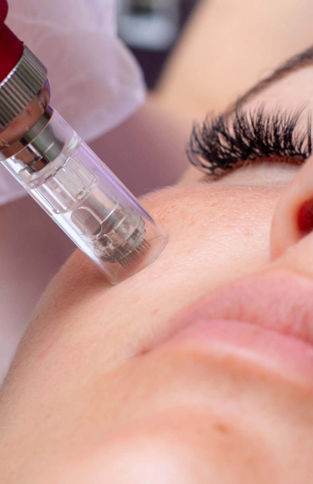 Micro-
Needling