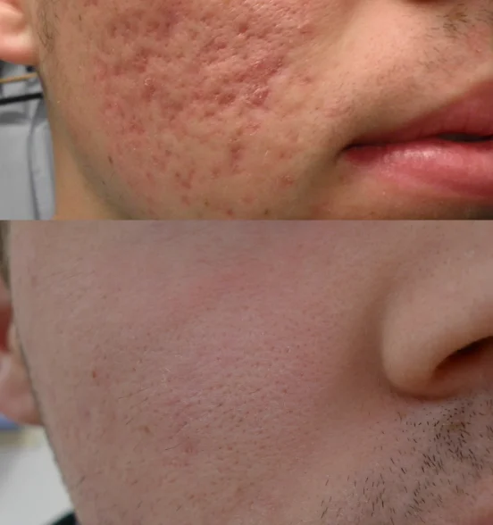 acne scarr