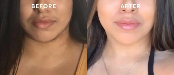 before after laser