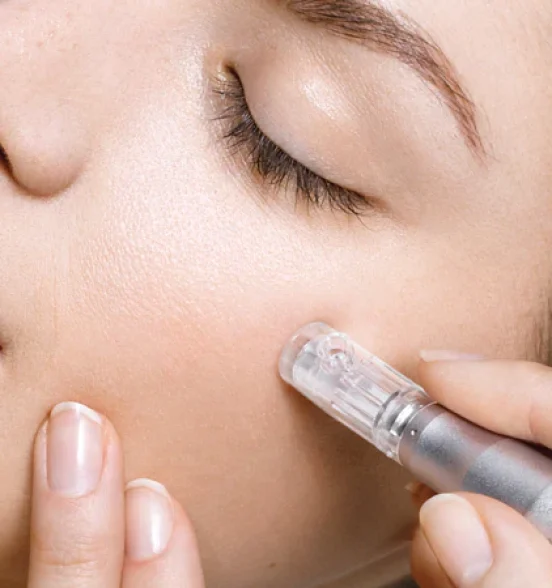 microneedling1_600x600